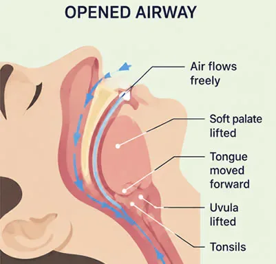 open airway sleep apnea diagram