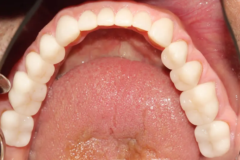 before full mouth restoration mouth Restoring Severe Tooth Wear with Full Crown Reconstruction - bottom teeth after
