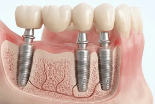 implant